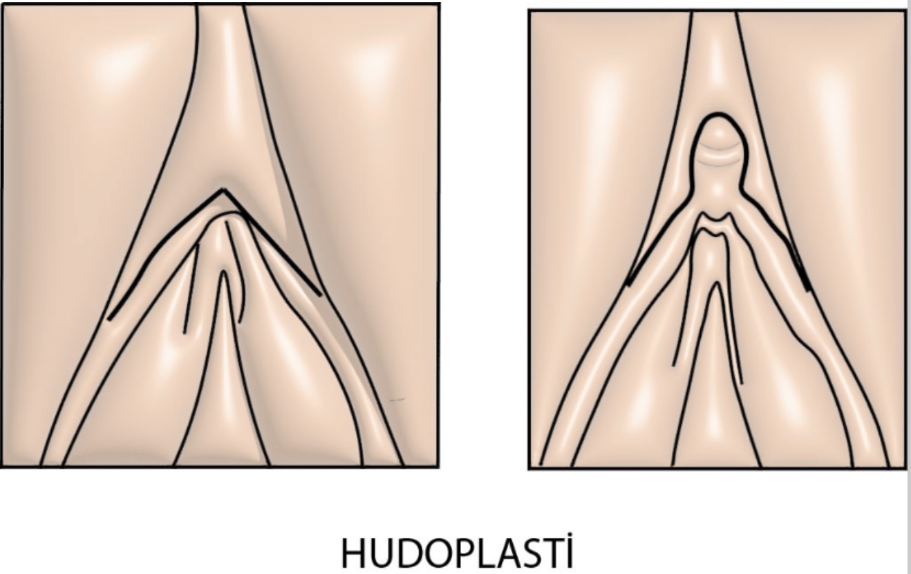 Hudoplasti Nedir? Klitoris Üzeri Deri Fazlalığı Nasıl Düzeltilir?